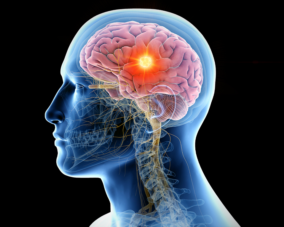 Ilustración exacta en 3d del cerebro humano con un tumor destacado