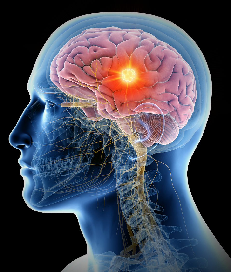 Ilustración exacta en 3d del cerebro humano con un tumor destacado
